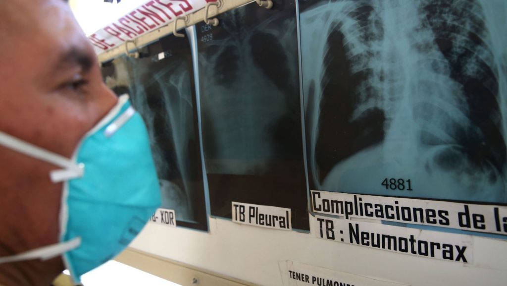 Minsa Inicia Tratamiento Totalmente Oral Para La Tuberculosis Mdr